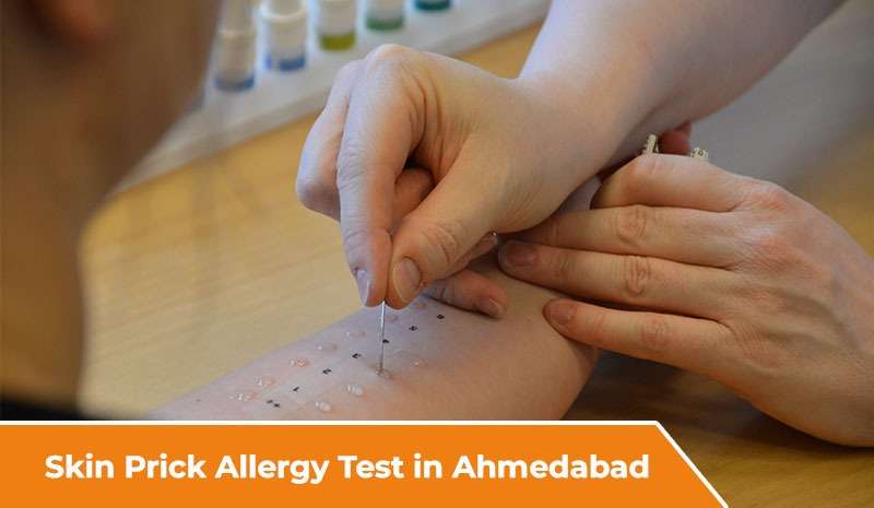 Skin Prick Allergy Test in Ahmedabad