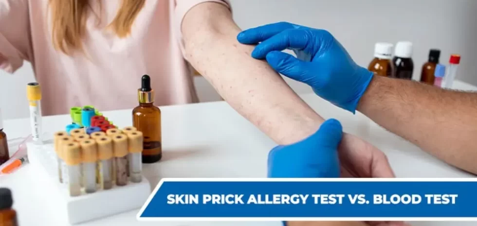 Skin Prick Allergy Test vs. Blood Test