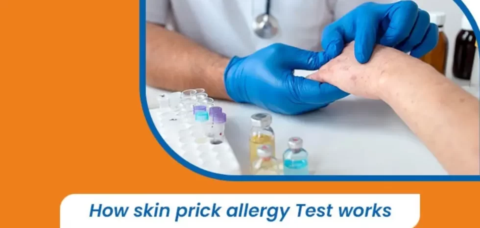 How Skin Prick Allergy Test Works