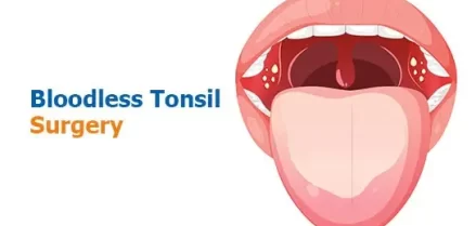 Bloodless Tonsil Surgery