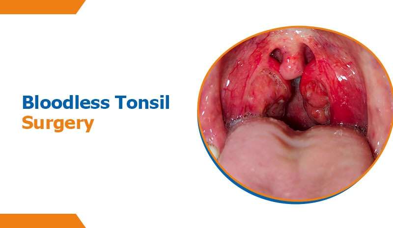 Bloodless Tonsil Surgery