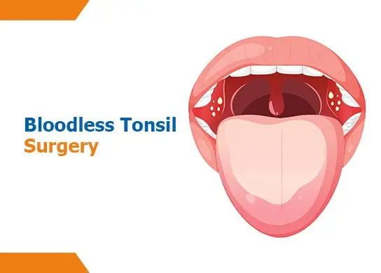 Bloodless Tonsil Surgery