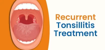 Recurrent Tonsillitis Treatment