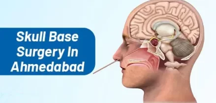 Skull Base Surgery in Ahmedabad