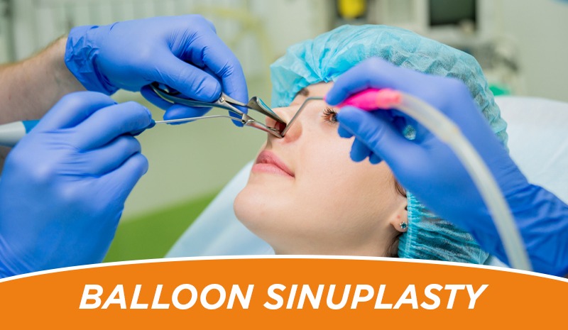 Balloon Sinuplasty